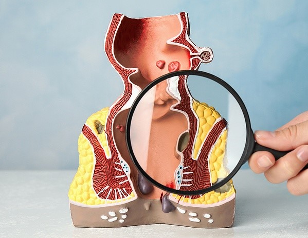 أمراض الشرج